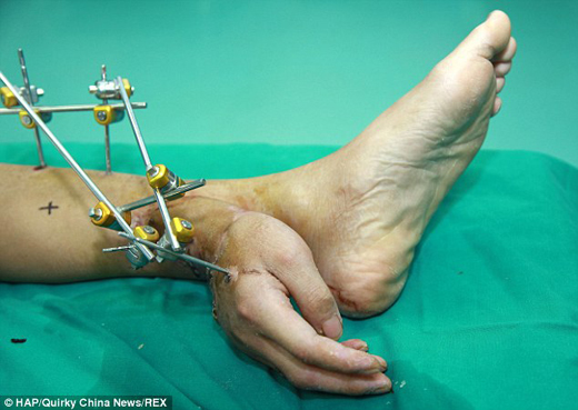 Severed hand attached